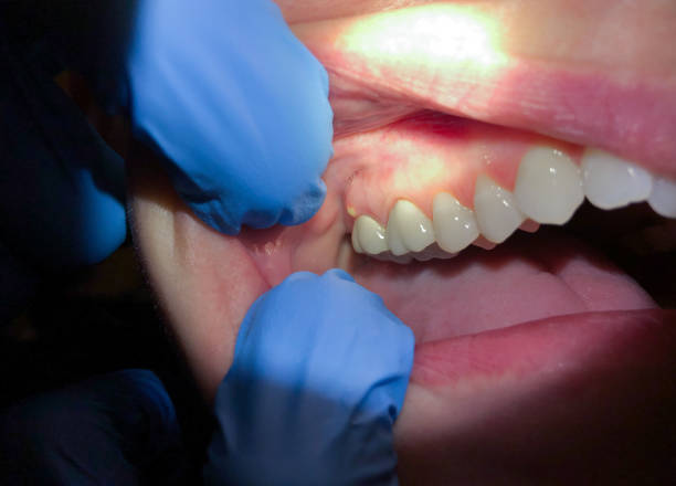 Best Emergency Denture Repair in Lake Sherwood, CA